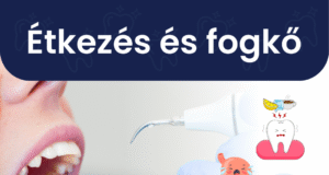 Hogyan szól bele az étkezésbe a fogkő?
